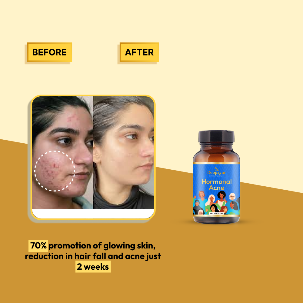 Hormonal Acne Multivitamin