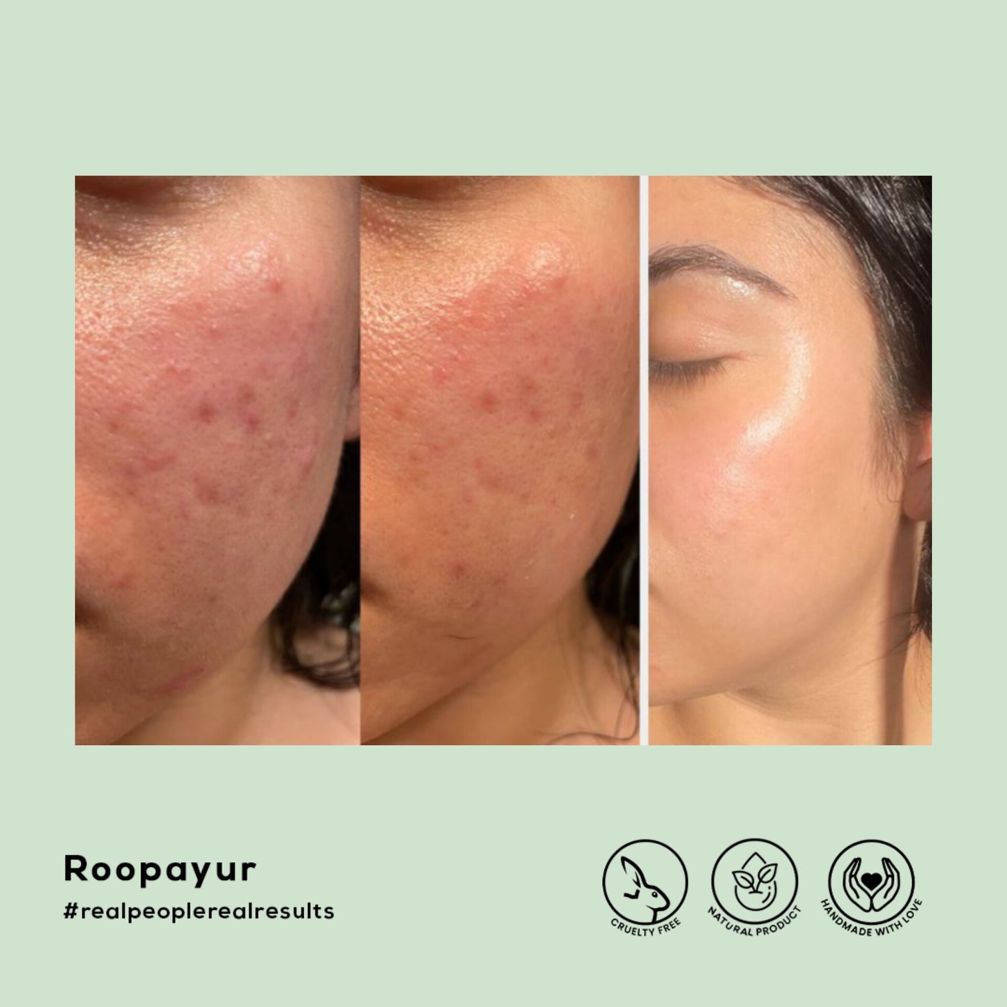 Roopayur Skin Healing Combo