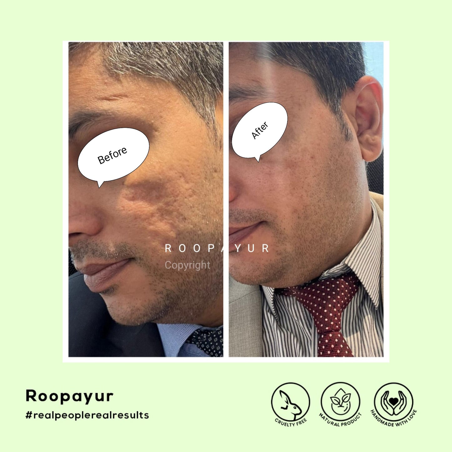 Roopayur Skin Healing Combo