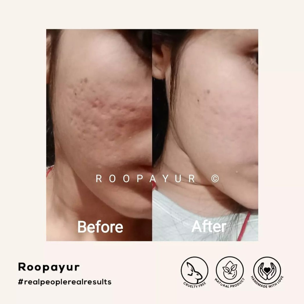 Roopayur Skin Healing Combo
