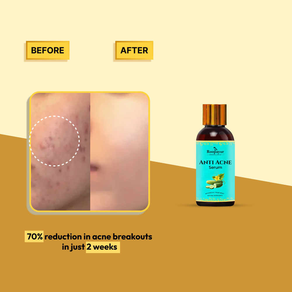 Roopayur Anti Acne Serum