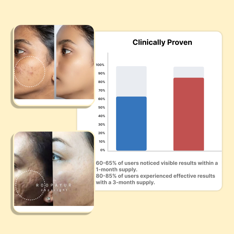 Roopayur Advanced Scars Healing Serum for Acne Scars & Pigmentation | ROOPAYUR