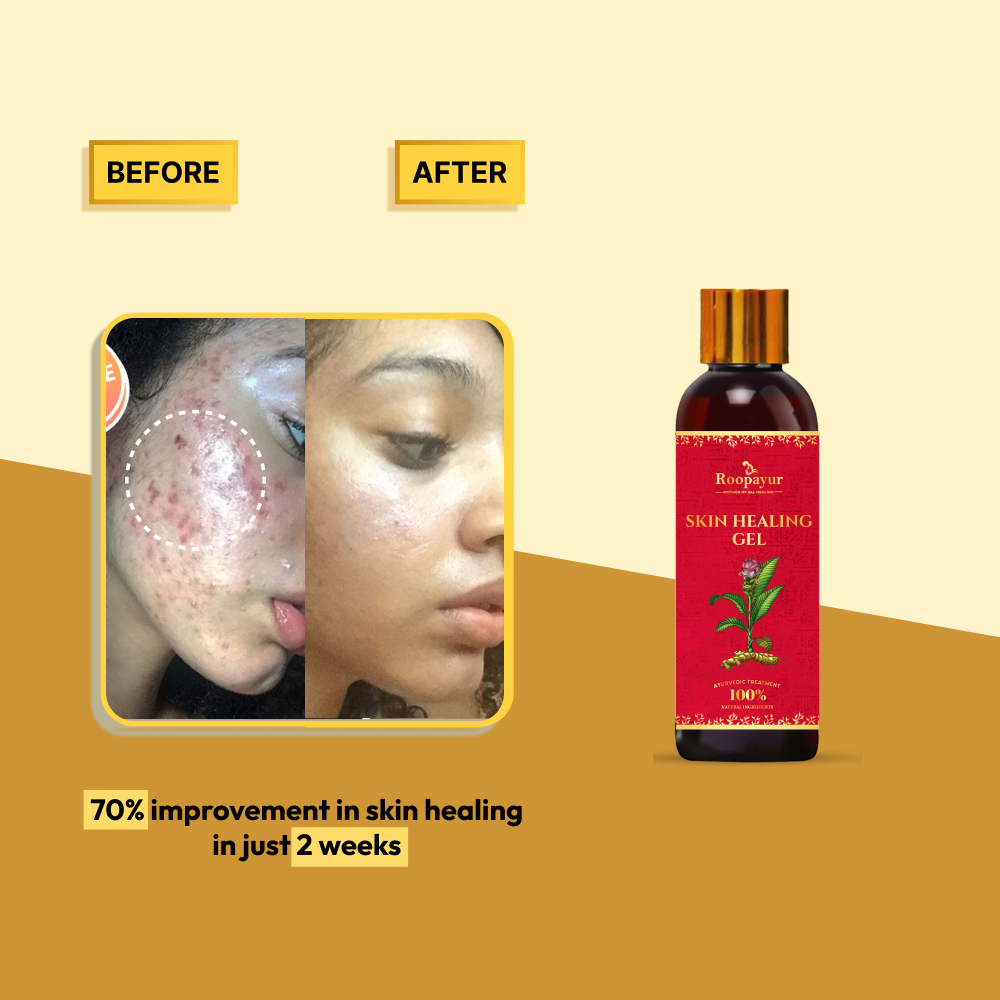 Roopayur Skin Healing Gel