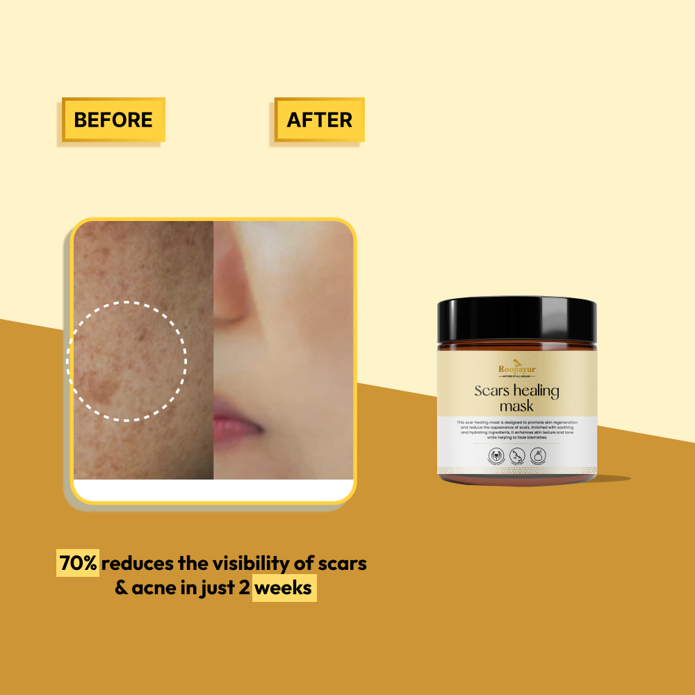 Roopayur Scars Healing Mask for Acne Scars & Skin Renewal | ROOPAYUR