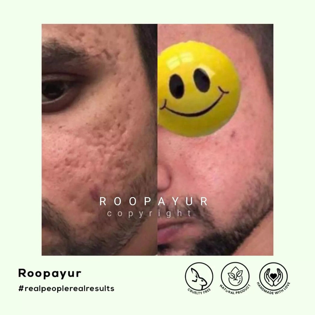 Roopayur Skin Healing Combo