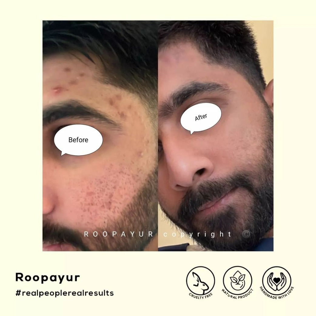 Roopayur Skin Healing Combo